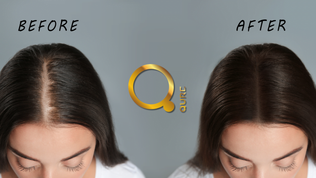 Woman Before and After Redensyl Anti Hair Loss Scalp Treatment